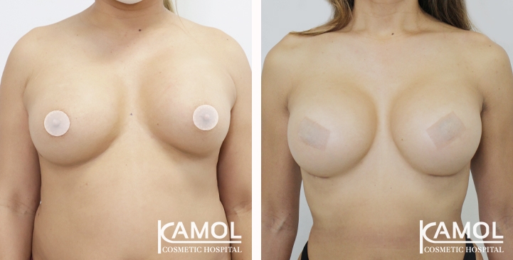 Revisão de Implantes Mamários 6 lg 6668464539336 image