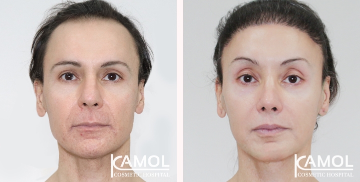 Cirurgia de Feminização Facial / FFS 72 lg 6669930b70f9d image