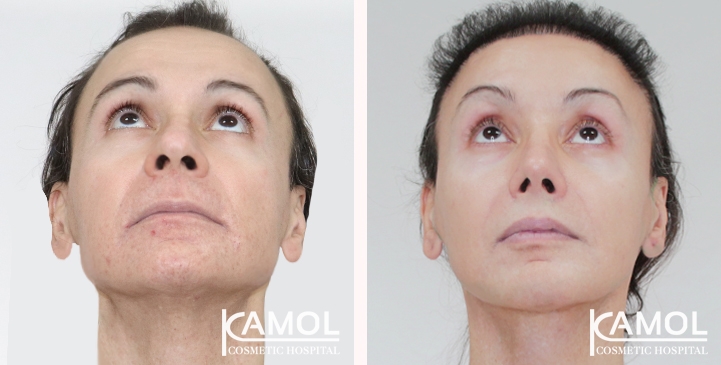 Cirurgia de Feminização Facial / FFS 73 lg 6669930edb62c image