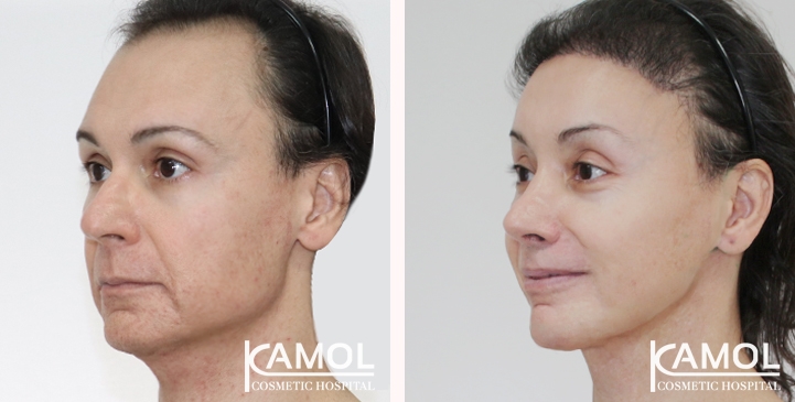 Cirurgia de Feminização Facial / FFS 75 lg 666993112d4bb image