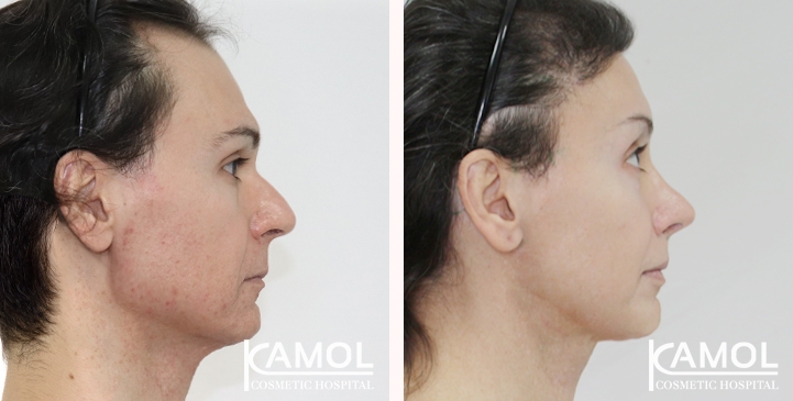 Cirurgia de Feminização Facial / FFS 76 lg 66699316343b7 image