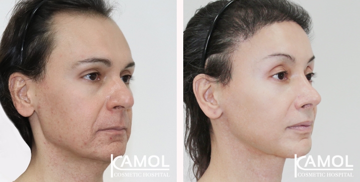 Cirurgia de Feminização Facial / FFS 74 lg 66699318ebd2b image