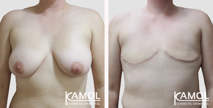 Chirurgie du Torse / Mastectomie 82 lg 66a5cf8d3ad86 image
