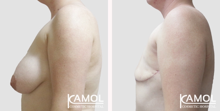 Chirurgie du Torse / Mastectomie 80 lg 66a5cf8d67145 image