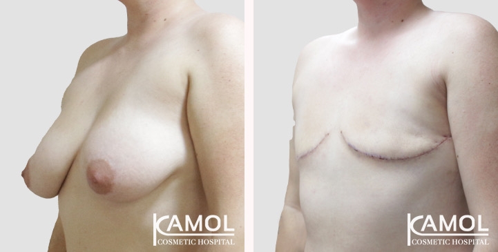Chirurgie du Torse / Mastectomie 81 lg 66a5cf8d83fe4 image