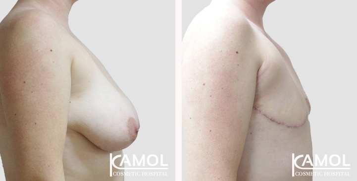 Chirurgie du Torse / Mastectomie 79 lg 66a5cf8da2754 image