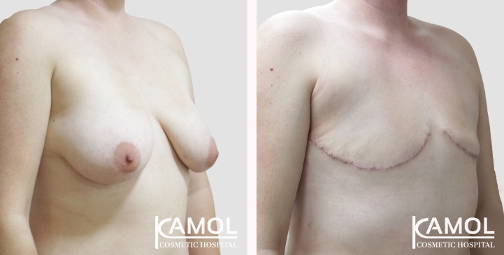 Chirurgie du Torse / Mastectomie 78 lg 66a5cf8dc38af image