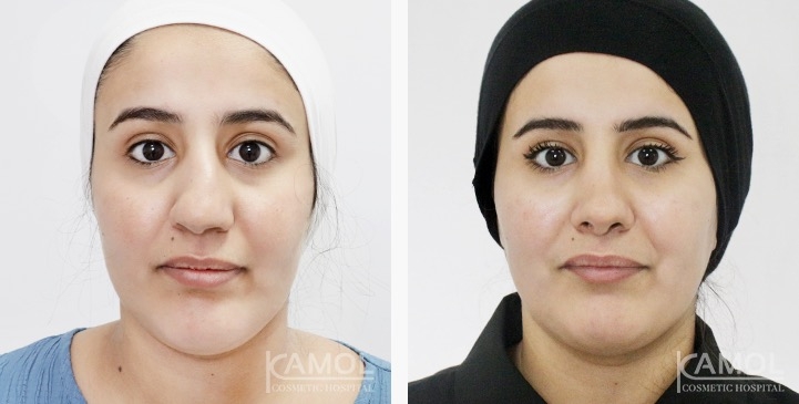 Rinoplastia 8 lg 6749dcd609bdc image