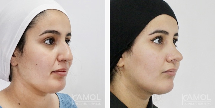 Rinoplastia 12 lg 6749dcda308eb image