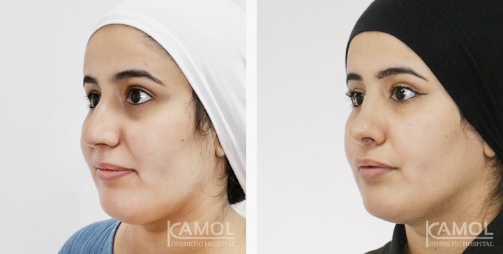 Rinoplastia 11 lg 6749dce54178b image