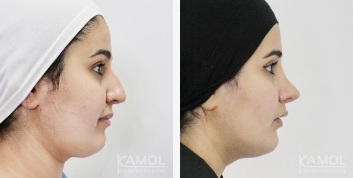 Rinoplastia 10 lg 6749dcece5c2a image