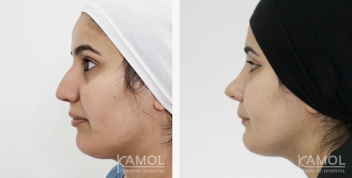 Rinoplastia 9 lg 6749dced0993f image