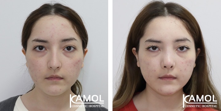 Rinoplastia 2 lg 67541e82ae2df image