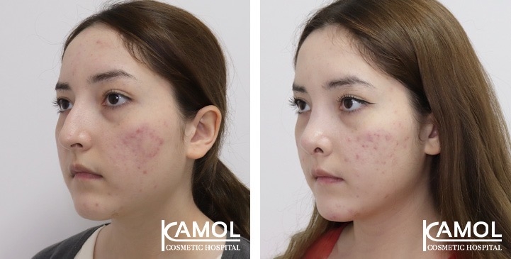 Rinoplastia 4 lg 67541e8385d18 image