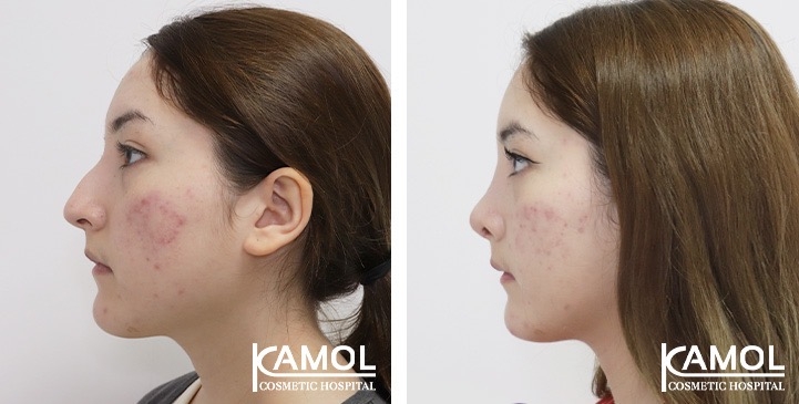 Rinoplastia 6 lg 675424dfd040b image