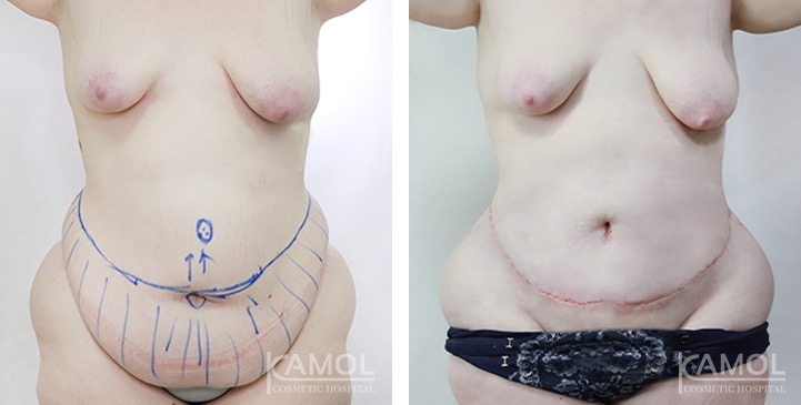 Contouring Corporeo / Lipectomia 2 lg 675427e21f133 image