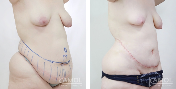 Contouring Corporeo / Lipectomia 6 lg 675427e23fbf5 image