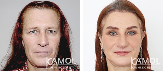Cirurgia de Feminização Facial / FFS 2 lg 649f892cad9a8 image