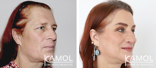 Cirurgia de Feminização Facial / FFS 3 lg 649f892caf2c3 image