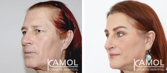 Cirurgia de Feminização Facial / FFS 4 lg 649f892cb0bbc image