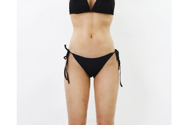 How to get ready for liposuction 6 lg 649980b508a65 image 1 1