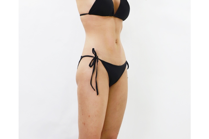 How to get ready for liposuction 5 lg 649980b50a83a image 1 1